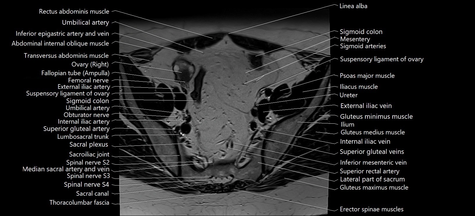 Axial cross sectional anatomy of female pelvis (MRI 3T) image 7.webp